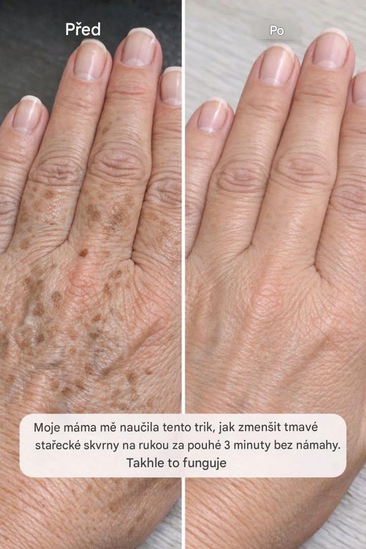 Maminka mě naučila tenhle trik, jak zmenšit tmavé stařecké skvrny na rukou za pouhé 3 minuty bez námahy. Funguje to takto.
