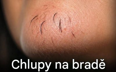 Chloupky na bradě u žen: co se vám vaše tělo může snažit říct